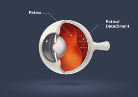 u of m retina detachment surgery