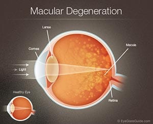 macular-degeneration-diagram_00