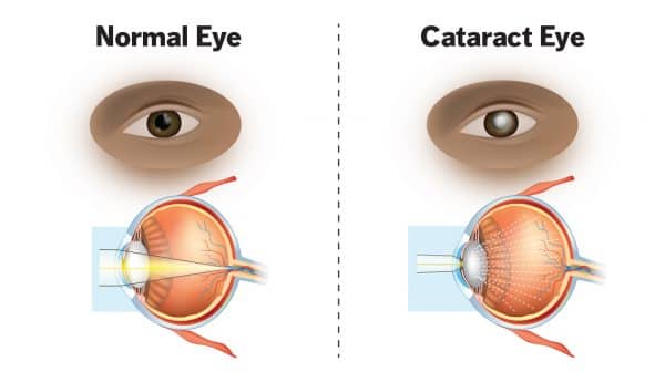 1140-infographic-normal-eye-versus-cataract-eye.imgcache.rev8f6f1c256de898f611fa165533b345b3